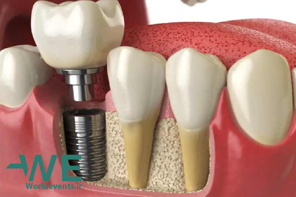 کاشت دندان به چه صورت انجام می شود ؟